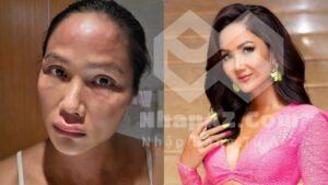 Hoa hậu H'Hen Niê bị nổi mề đay sau sinh: Nguyên nhân và dấu hiệu nhận biết