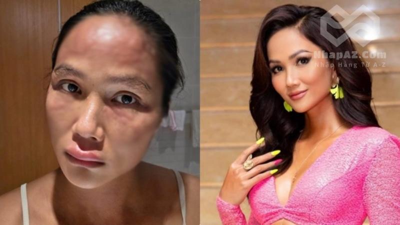 Hoa hậu H'Hen Niê bị nổi mề đay sau sinh: Nguyên nhân và dấu hiệu nhận biết Hoa hậu H'Hen Niê bị nổi mề đay sau sinh: Nguyên nhân và dấu hiệu nhận biết