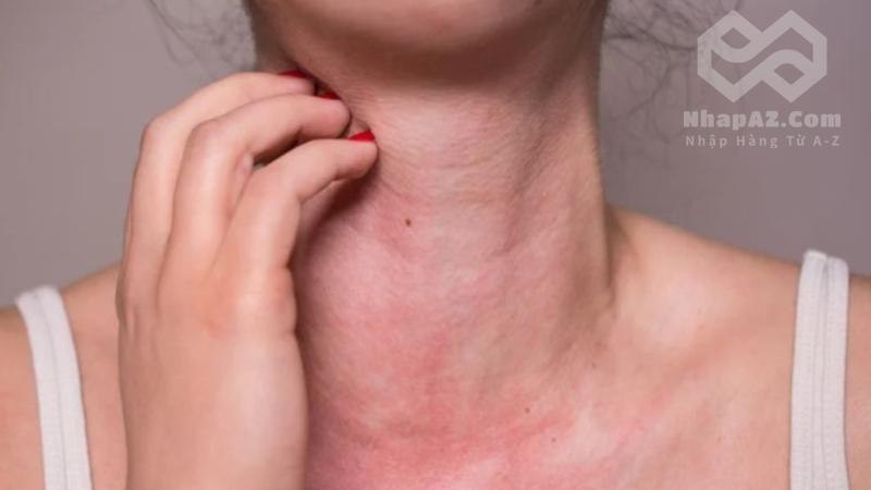 Hoa hậu H'Hen Niê bị nổi mề đay sau sinh: Nguyên nhân và dấu hiệu nhận biết Vì sao mẹ sau sinh dễ bị nổi mề đay?